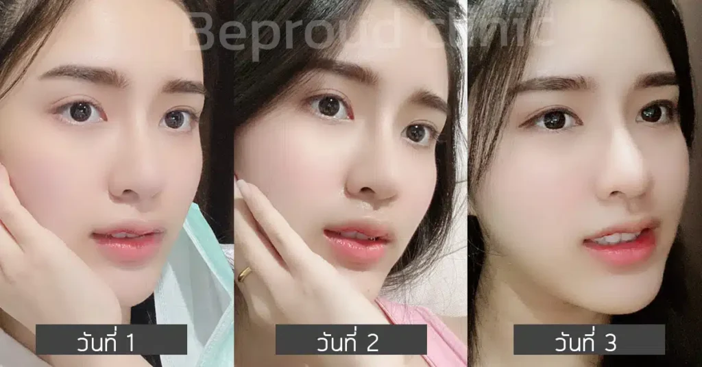 หลังทำตาสองชั้น ปากกระจับ ที่บีพราวด์