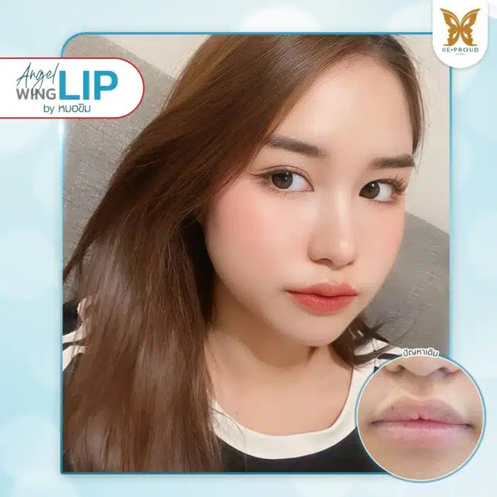 ศัลยกรรมปากกระจับ