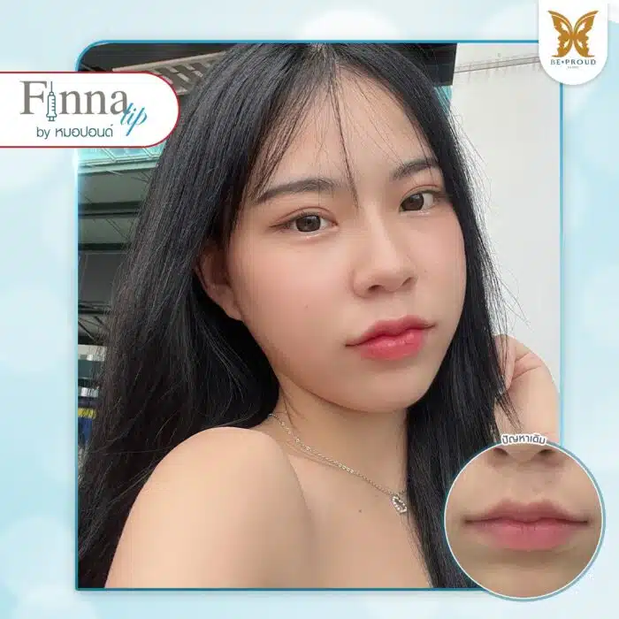 ฟิลเลอร์ปาก