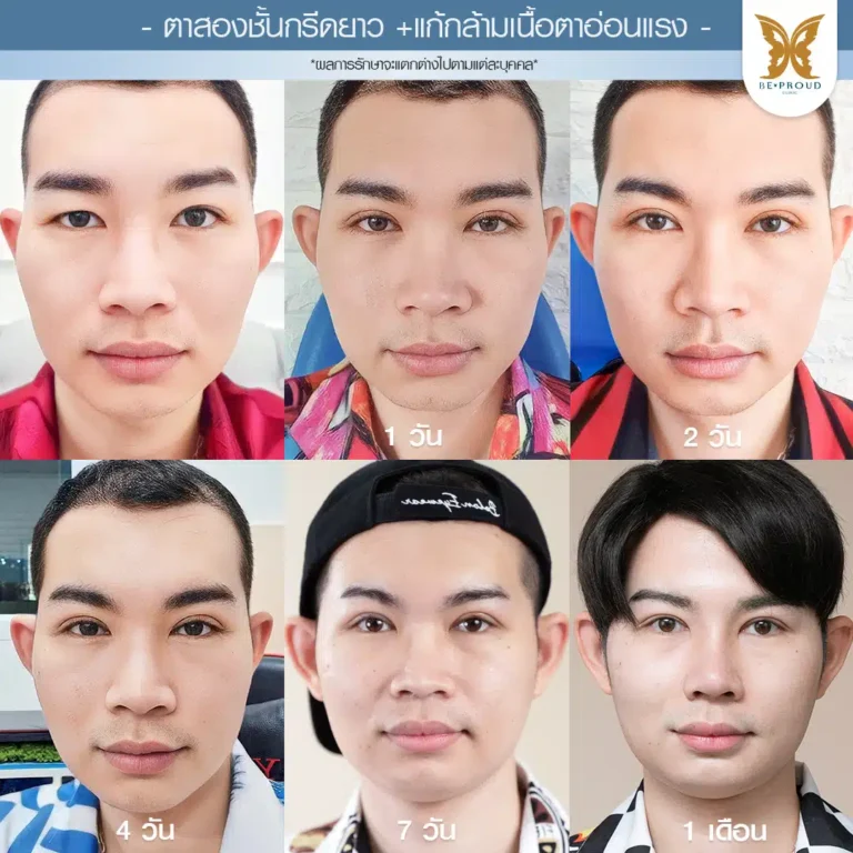 ตาสองชั้นกรีดตายาว แก้กล้ามเนื้อตาอ่อนแรง