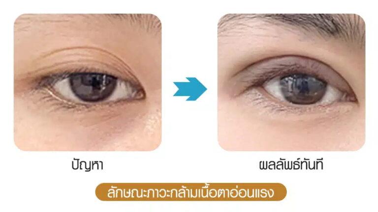 ภาวะกล้ามเนื้อตาอ่อนแรง