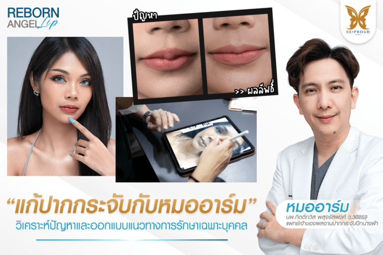 หัตถการแก้ปากกระจับปีกนางฟ้า บีพราวด์