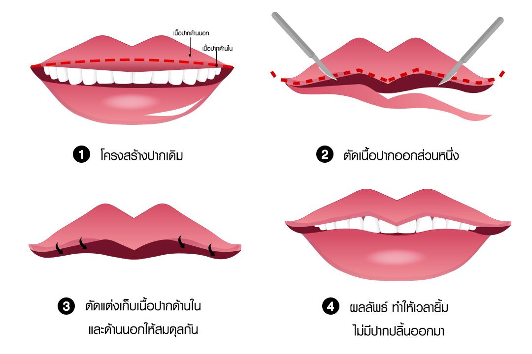 ภาพอินโฟกราฟิก 4 ขั้นตอน เทคนิคการทำบาลานซ์เนื้อปาก โดยมีการตัดเนื้อปากด้านในส่วนเกินออกและเย็บเก็บให้สมดุล เพื่อให้ผลลัพธ์รอยยิ้มสวยงามเป็นธรรมชาติ