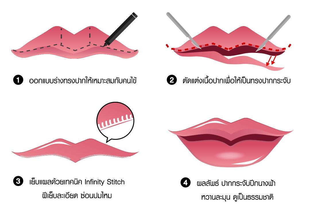 Infographic ขั้นตอนการทำปากกระจับปีกนางฟ้า 4 ขั้นตอน ออกแบบ, ตัดแต่ง, เย็บ Infinity Stitch, และผลลัพธ์ปากกระจับปีกนางฟ้า บีพราวด์คลินิก