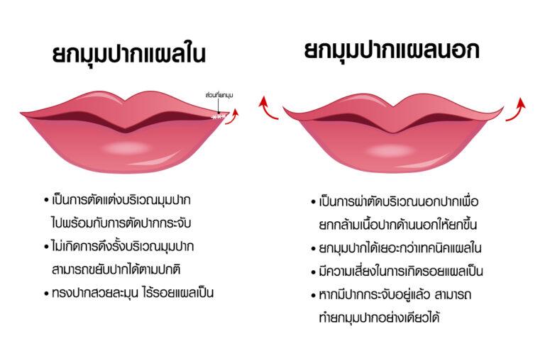 อินโฟกราฟิกเปรียบเทียบศัลยกรรมยกมุมปาก 2 เทคนิค ระหว่าง ยกมุมปากแผลใน (ซ้าย) และ ยกมุมปากแผลนอก (ขวา) ที่บีพราวด์คลินิก