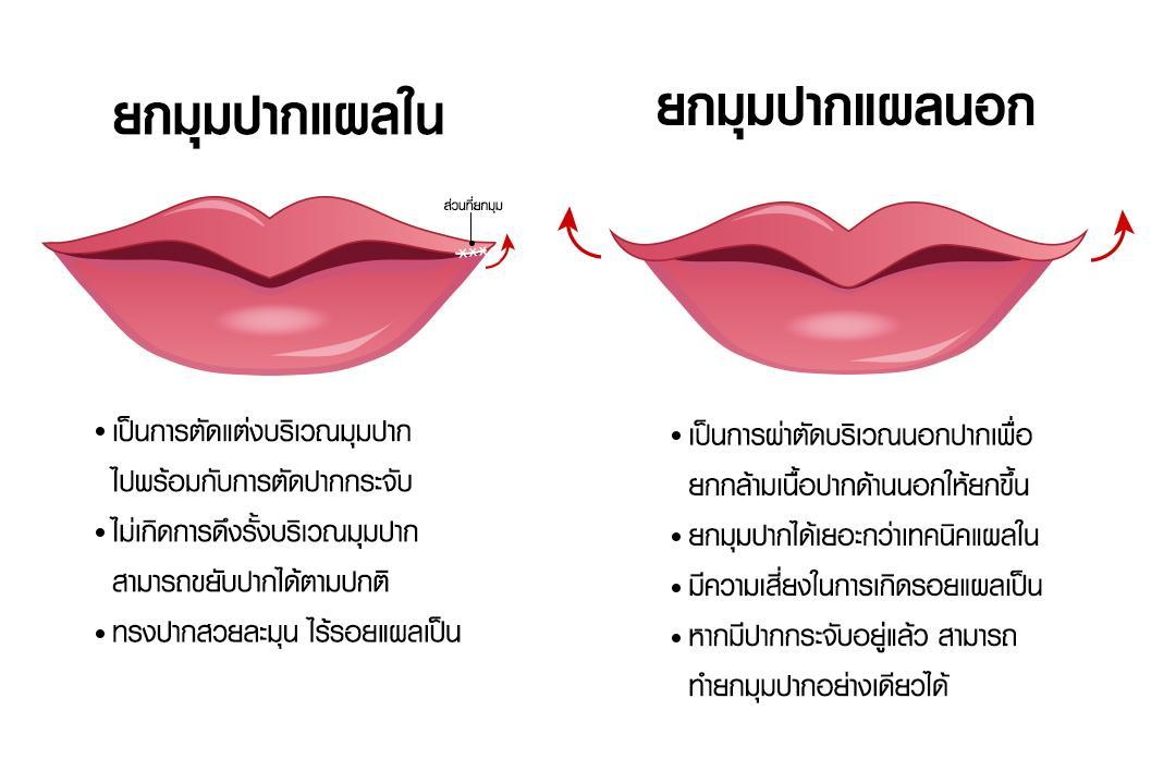 อินโฟกราฟิกเปรียบเทียบศัลยกรรมยกมุมปาก 2 เทคนิค ระหว่าง ยกมุมปากแผลใน (ซ้าย) และ ยกมุมปากแผลนอก (ขวา) ที่บีพราวด์คลินิก