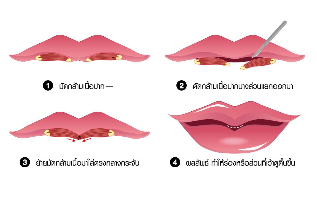อินโฟกราฟิก 4 ขั้นตอนการศัลยกรรมสร้างติ่งกระจับด้วยเทคนิคย้ายกล้ามเนื้อปาก โดยนำกล้ามเนื้อบางส่วนมาเย็บรวมกันตรงกลางริมฝีปากบน เพื่อผลลัพธ์ที่นูนสวยและเป็นธรรมชาติ