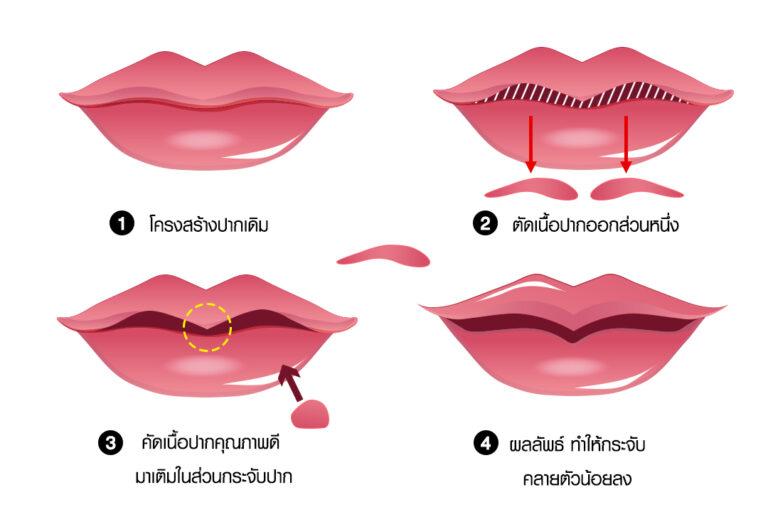 อินโฟกราฟิก 4 ขั้นตอนการศัลยกรรมปากกระจับเทคนิคลิปกราฟ (Lip Graft) เริ่มจากโครงสร้างปากเดิม, ตัดเนื้อส่วนเกิน, ย้ายเนื้อเยื่อดีมาเติมในส่วนกระจับปาก และผลลัพธ์ทรงปากกระจับคลายตัวน้อยลง ที่บีพราวด์คลินิก