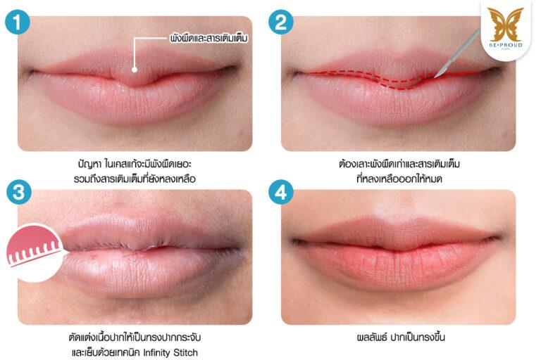 หัตถการแก้ปากกระจับปีกนางฟ้า บีพราวด์