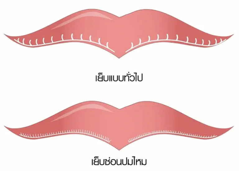 ภาพเปรียบเทียบ เทคนิคการเย็บแผลปากกระจับ ระหว่างการเย็บแบบทั่วไป กับเทคนิค Infinity Stitch (เย็บซ่อนปมไหม) ให้ฝีเย็บเรียบเนียนและละเอียดกว่าที่บีพราวด์คลินิก