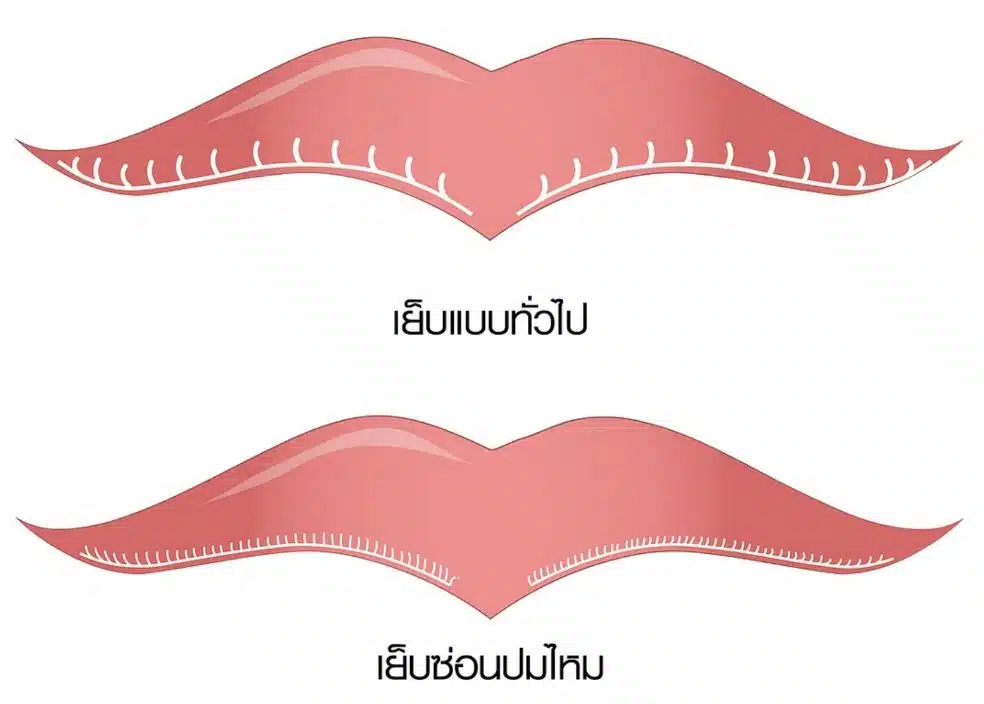 ภาพเปรียบเทียบ เทคนิคการเย็บแผลปากกระจับ ระหว่างการเย็บแบบทั่วไป กับเทคนิค Infinity Stitch (เย็บซ่อนปมไหม) ให้ฝีเย็บเรียบเนียนและละเอียดกว่าที่บีพราวด์คลินิก