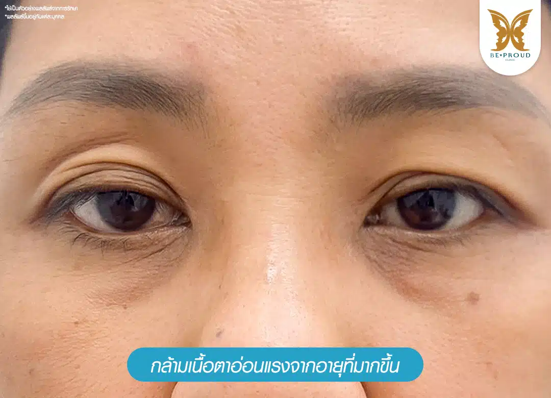 กล้ามเนื้อตาอ่อนแรงจากอายุที่มากขึ้น