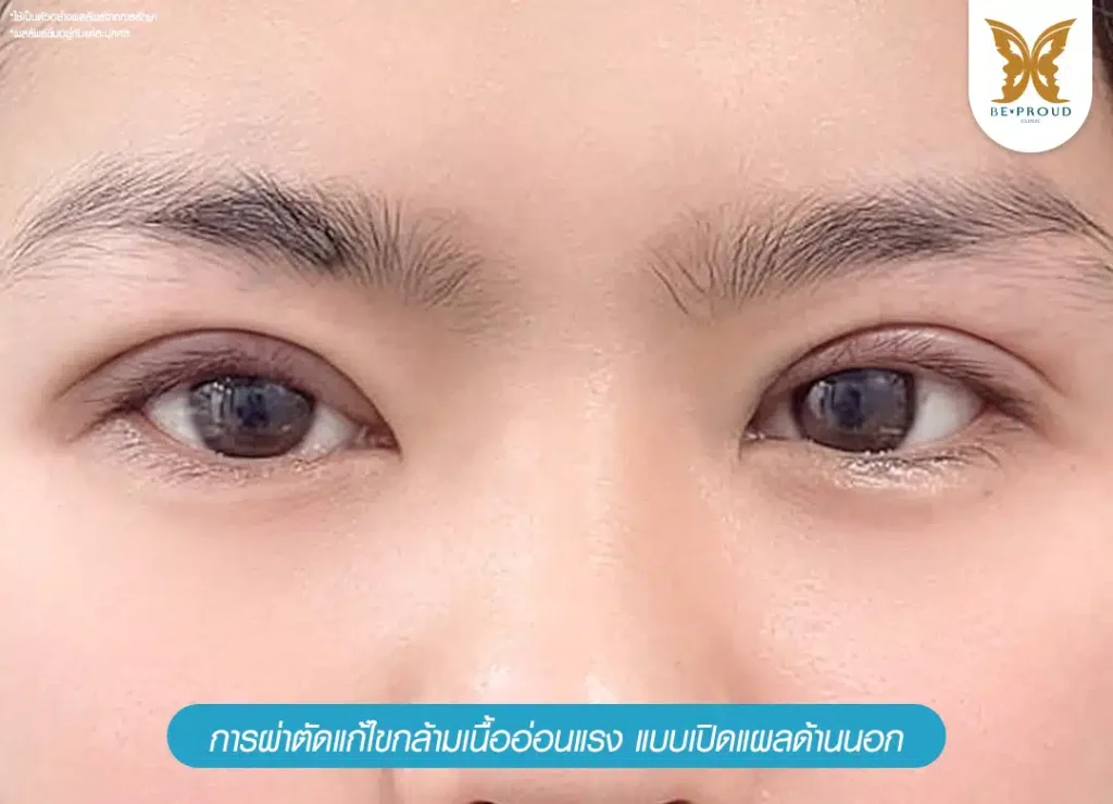 ผ่าตัดแก้ไขกล้ามเนื้ออ่อนแรง เปิดแผลด้านนอก