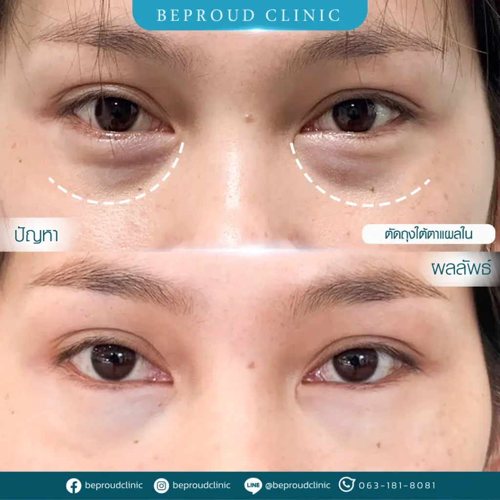 ตัดถุงใต้ตาแผลใน