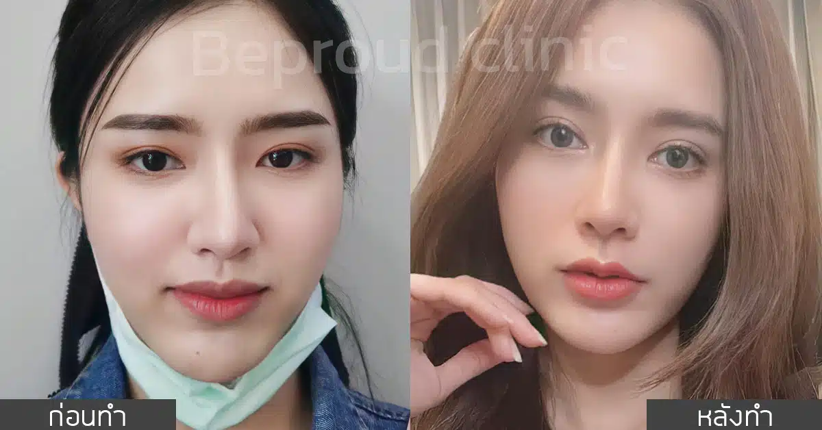 หลังทำตาสองชั้น ปากกระจับ ที่บีพราวด์