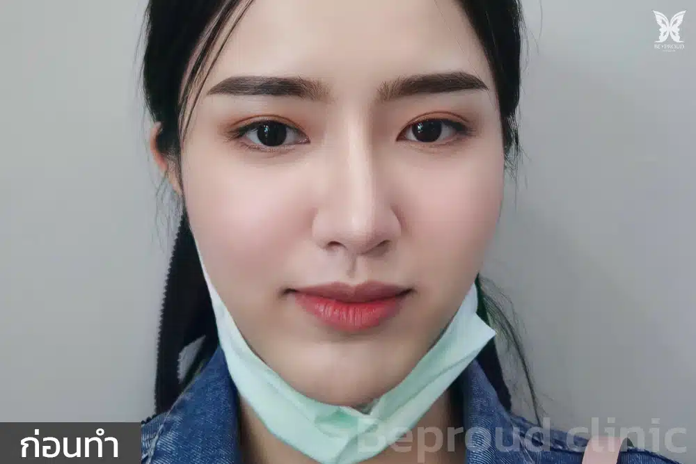 หลังทำตาสองชั้น ปากกระจับ ที่บีพราวด์