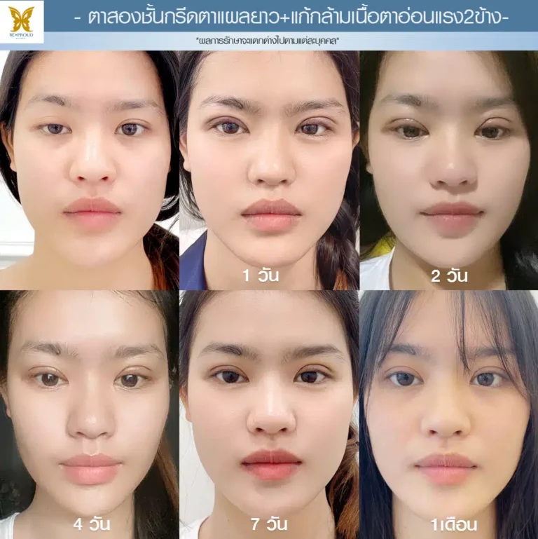 ตาสองชั้นกรีดตายาว แก้กล้ามเนื้อตาอ่อนแรง