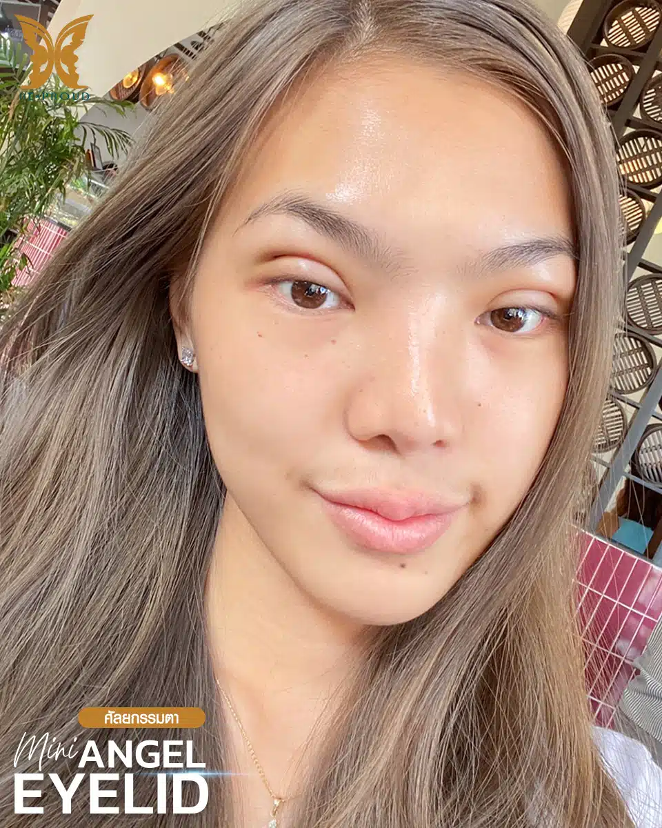 ตาสองชั้นกรีดยาวแผลมินิ