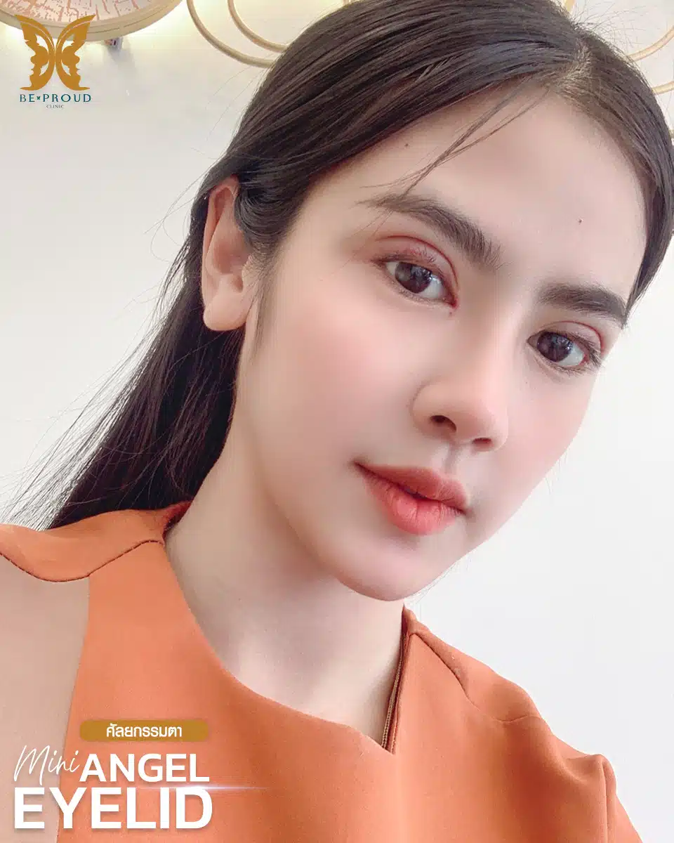 ตาสองชั้นกรีดยาวแผลมินิ