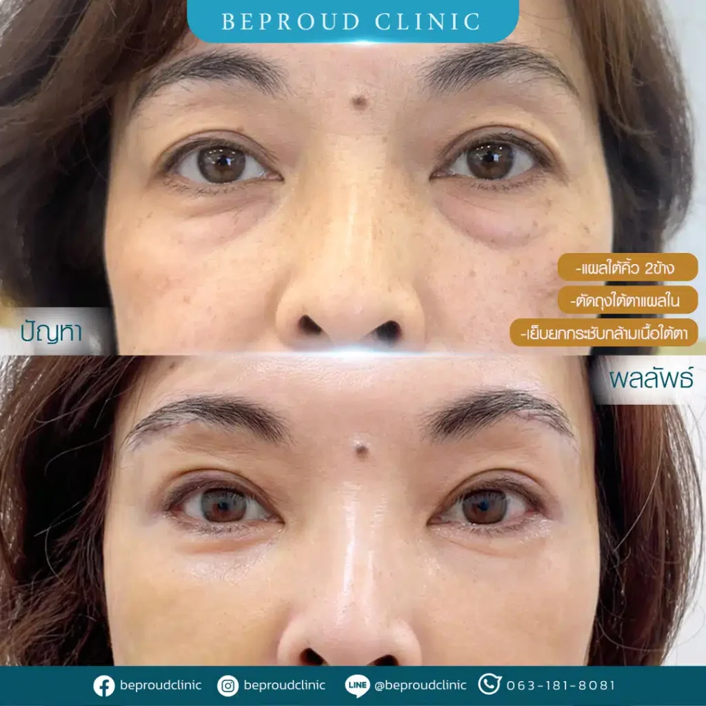 แผลใต้คิ้ว ตัดถุงใต้ตาแผลใน เย็บยกกระชับกล้ามเนื้อใต้ตา