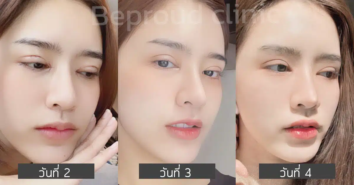 หลังทำตาสองชั้น ปากกระจับ ที่บีพราวด์