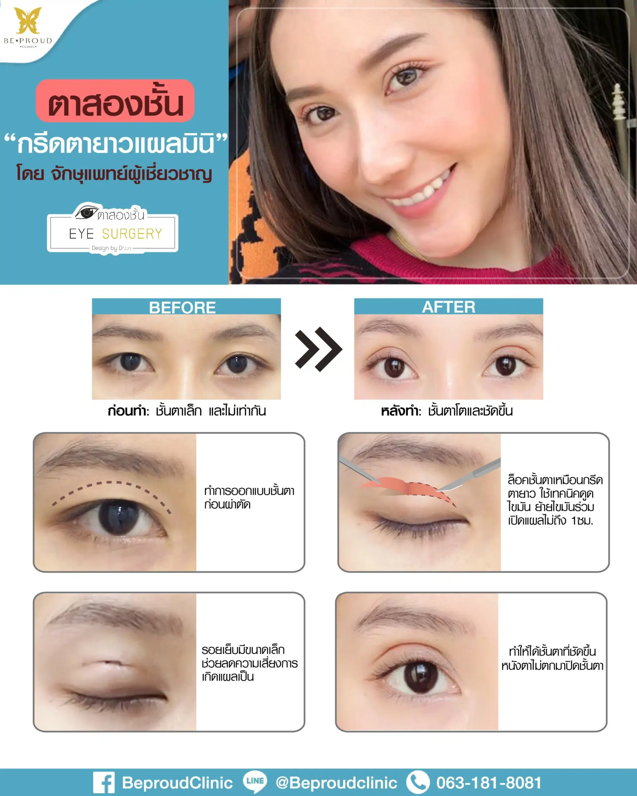 ตาสองชั้นกรีดตายาวแผลมินิ