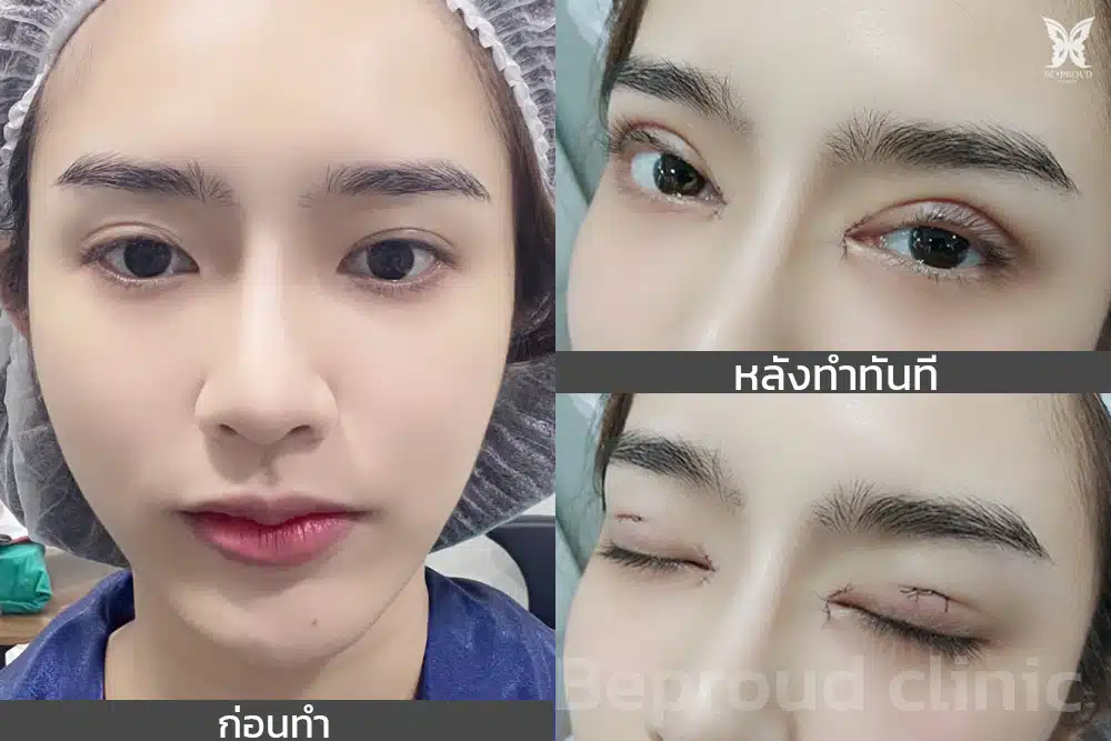 หลังทำตาสองชั้น ปากกระจับ ที่บีพราวด์