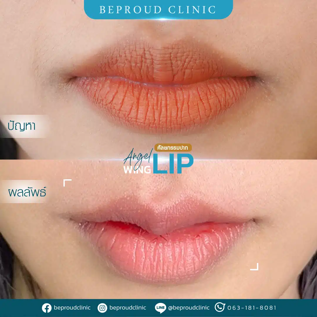 ปากกระจับปีกนางฟ้า บีพราวด์