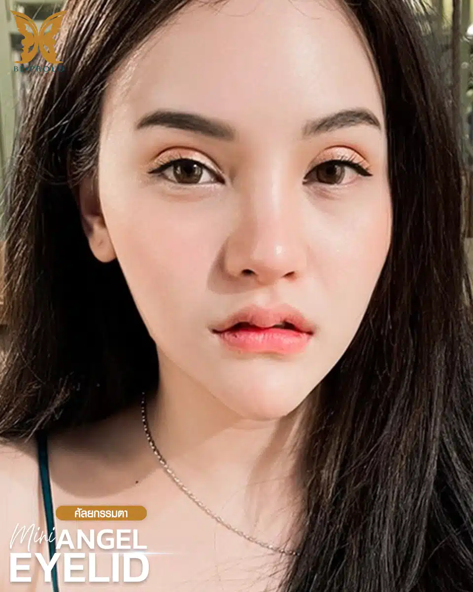 ตาสองชั้นกรีดยาวแผลมินิ