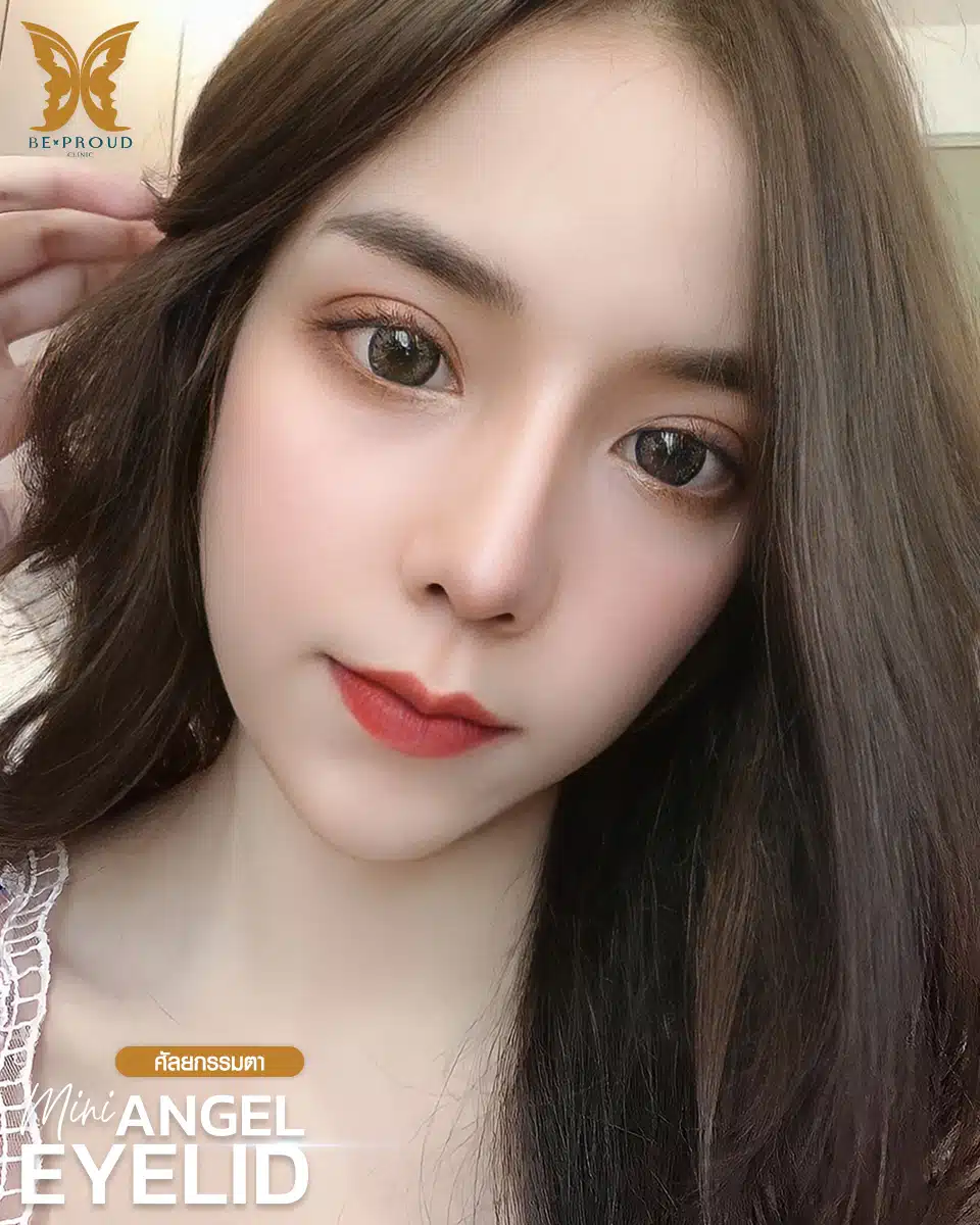 ตาสองชั้นกรีดยาวแผลมินิ