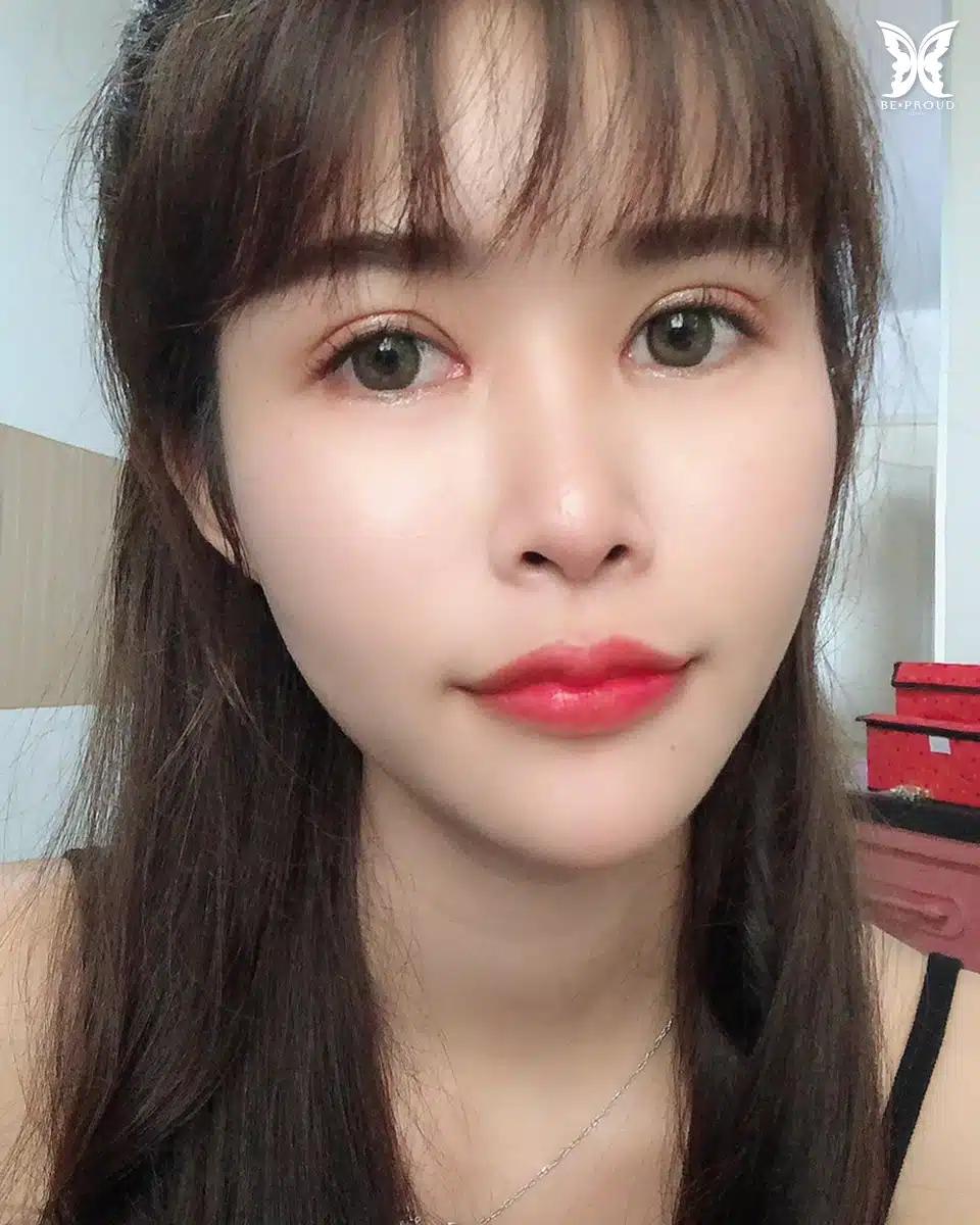 ตาสองชั้นกรีดยาวแผลมินิ