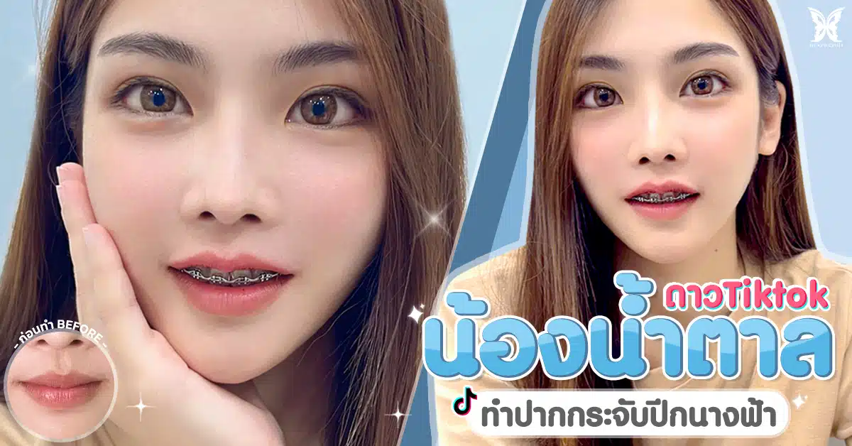 รีวิวทำปากกระจับปีกนางฟ้าของน้องน้ำตาล ดาว TikTok เปรียบเทียบภาพก่อนและหลังทำ ที่บีพราวด์คลินิก