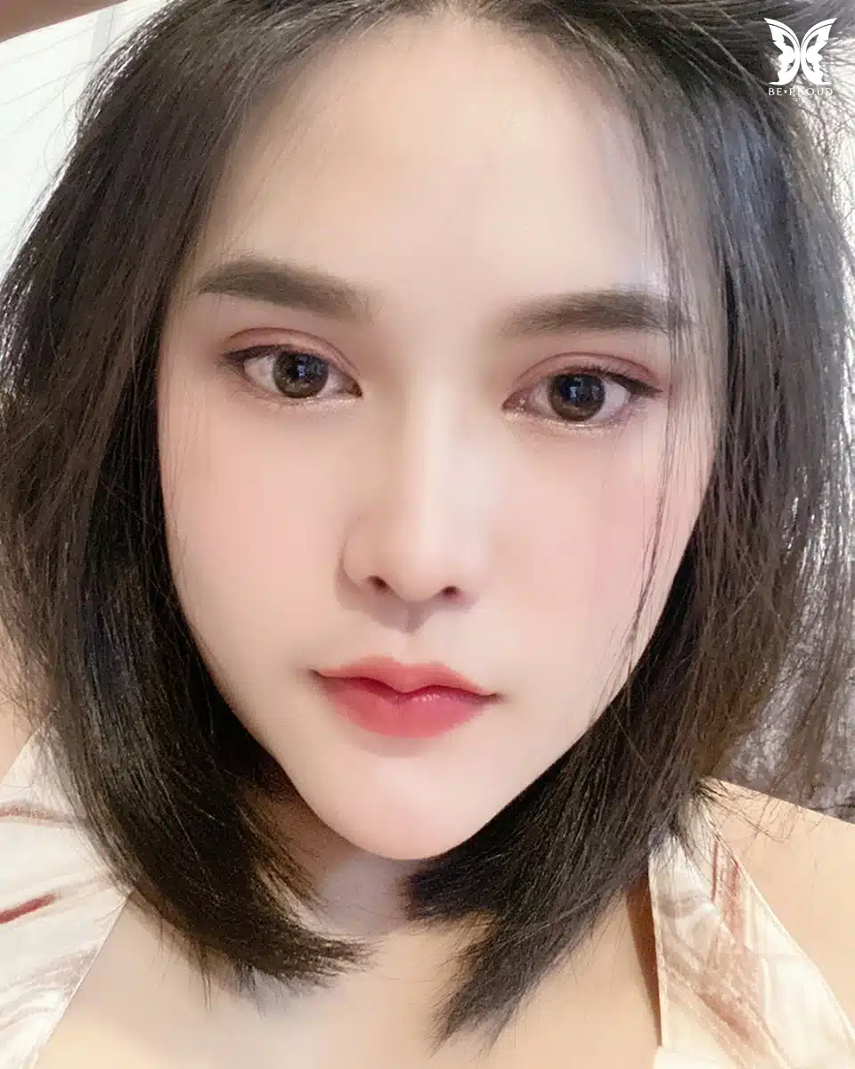 ตาสองชั้นกรีดยาวแผลมินิ