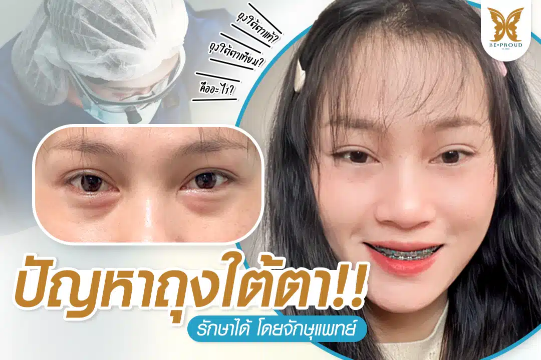 ปัญหาถุงใต้ตา