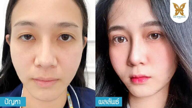 แก้กล้ามเนื้อตาอ่อนแรง