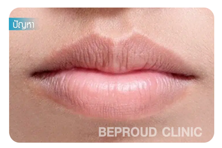 ศัลยกรรมปากกระจับ ปากคว่ำลง มุมปากตก