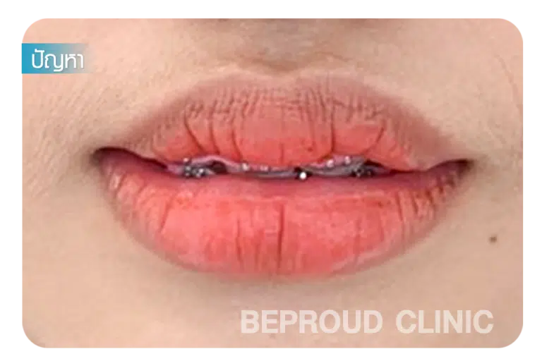 ศัลยกรรมปากกระจับ ริมฝีปากหนา เนื้อปากค่อนข้างเยอะ