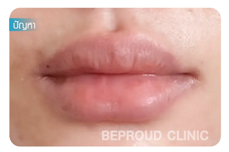 ศัลยกรรมปากกระจับ ปากที่เคยฉีดฟิลเลอร์มาก่อน