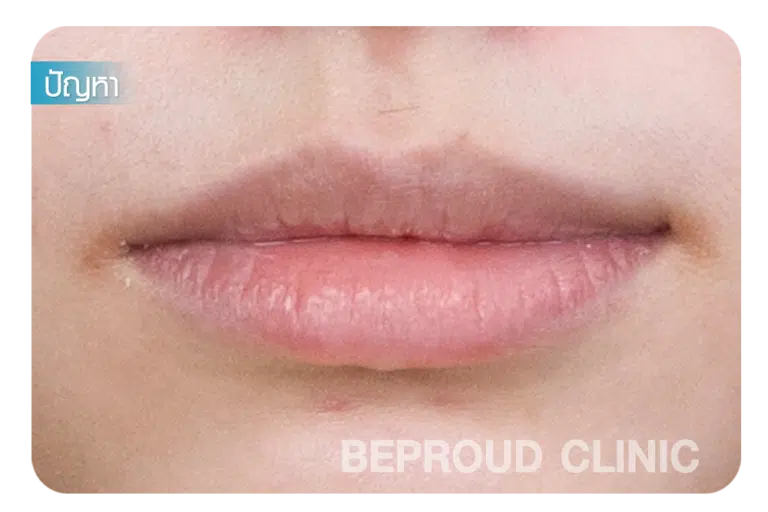 ศัลยกรรมปากกระจับ ปากไม่เท่ากัน