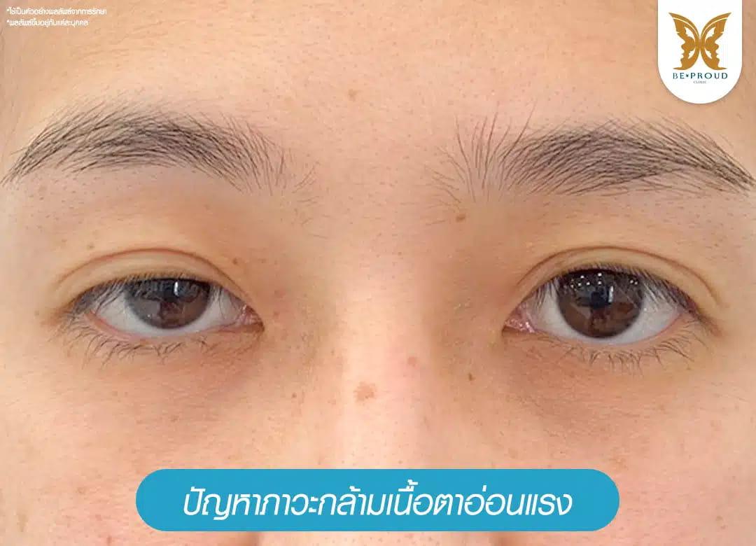 ภาวะกล้ามเนื้อตาอ่อนแรง หนังตาตก