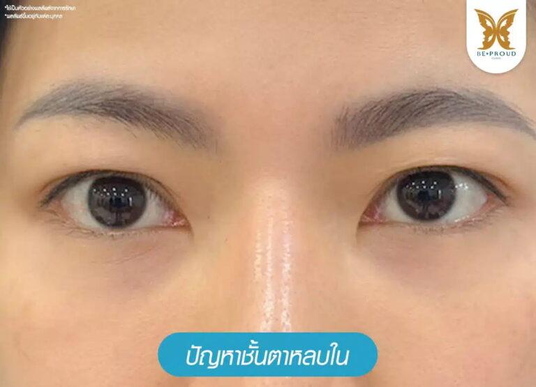 ปัญหาชั้นตาหลบใน