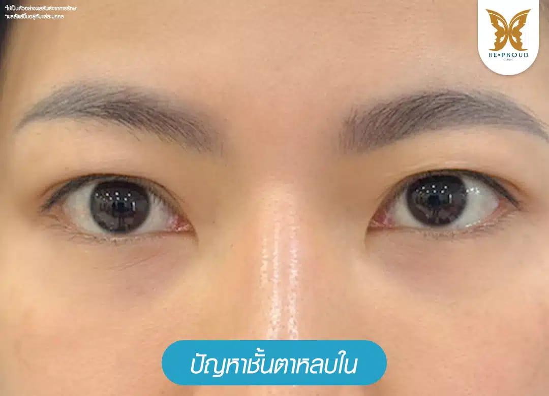 ปัญหาชั้นตาหลบใน