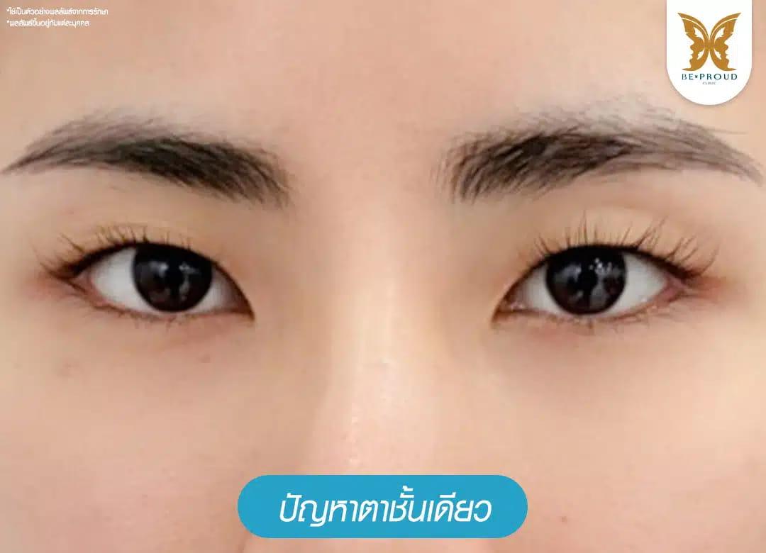 ปัญหาตาชั้นเดียวตั้งแต่เกิด