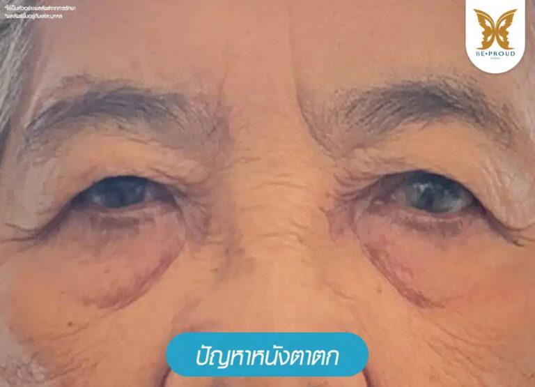 ปัญหาหนังตาตกจากอายุ