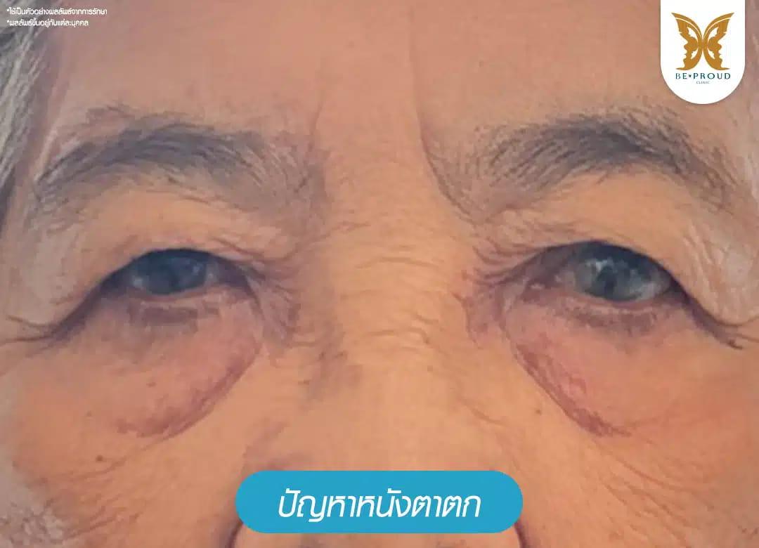 ปัญหาหนังตาตกจากอายุ