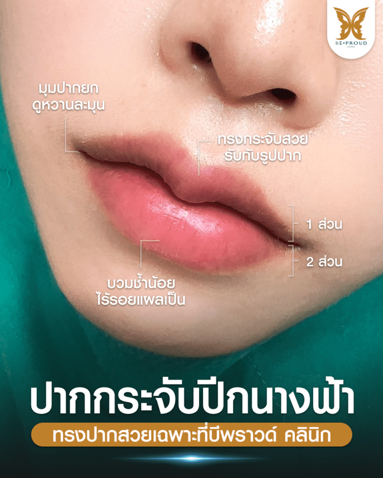 ภาพโคลสอัพปากกระจับปีกนางฟ้า แสดงมุมปากยก ทรงสวยได้สัดส่วน 1:2 บวมช้ำน้อย ไร้รอยแผลเป็น ทรงปากสวยเฉพาะที่บีพราวด์คลินิก