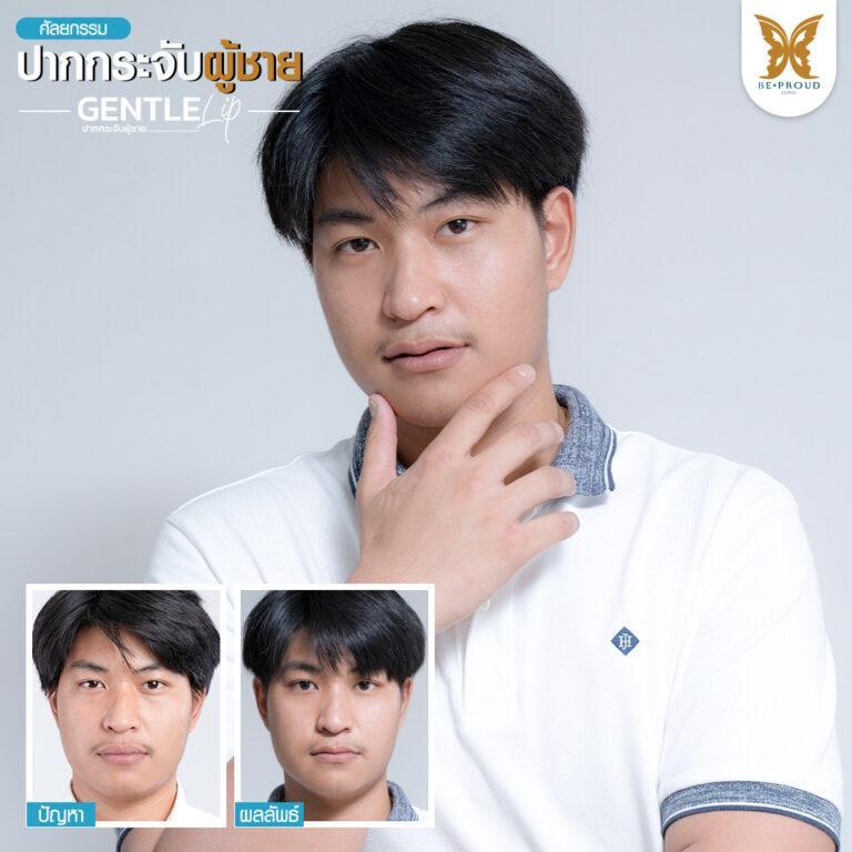 หัตถการปากกระจับผู้ชาย บีพราวด์