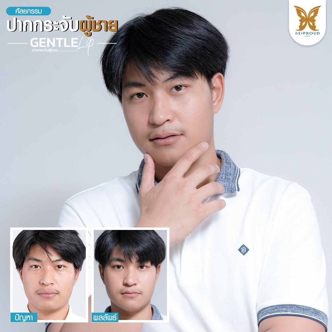 หัตถการปากกระจับผู้ชาย บีพราวด์