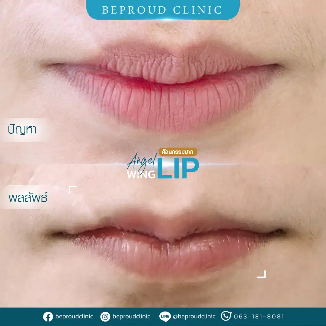 ปากกระจับปีกนางฟ้า บีพราวด์