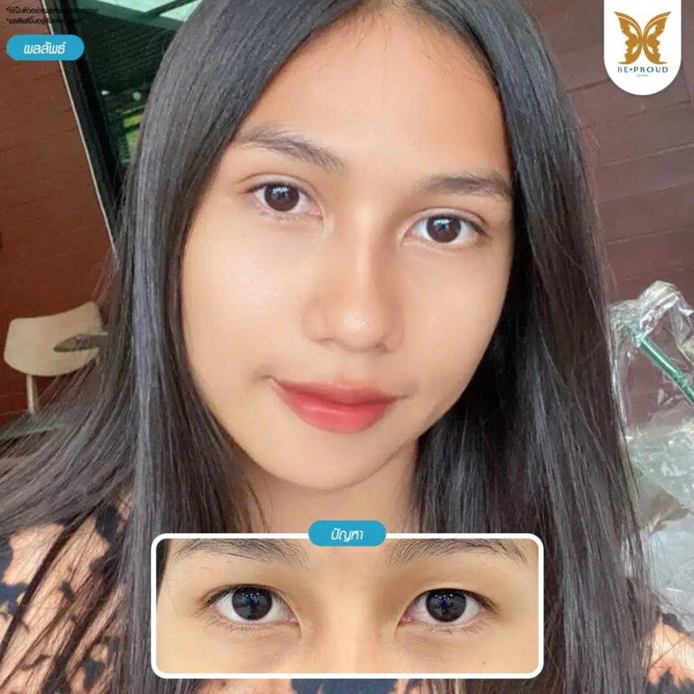 แก้กล้ามเนื้อตาอ่อนแรง